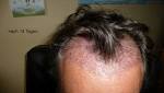 Haartransplantation dusseldorf kosten