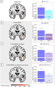Brain structural correlates of an impending initial major depressive  episode | Neuropsychopharmacology