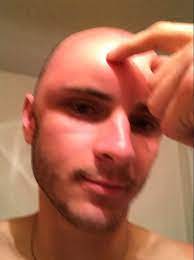 Dent Left In This Man S Head Is A Lesson In Why Everyone Should Always Apply Suncream World News Mirror Online