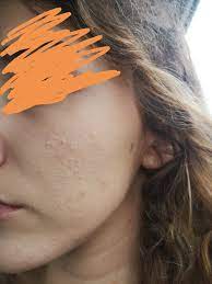Skin Concerns Closed Comedones Dehydrated Skin Need Help Please Skincareaddiction