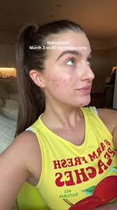 There are good days & bad days but still not regretting it! This medicine  really requires patience. #accutane #accutanejourney #accutaneupdate #acne  #adultacne #skincare #acnejourney #isotretinoina ...