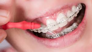 It is hard to reach the teeth in the back of your mouth. 12 Tips For Fighting Bad Breath With Braces Or Invisalign Fresh Orthodontics