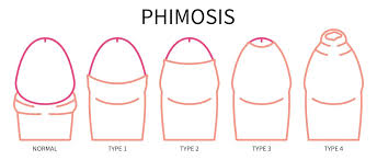 Image result for Phimosis