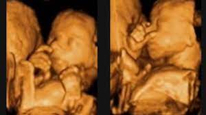 Zwillinge In Der 24 Woche Ssw 23 Babywelten Ch