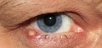 Weitere ideen zu gerstenkorn, gerste, schwedisch weben. Gerstenkorn Ursachen Beschwerden Diagnose Behandlung Prognose Vorbeugung Gesundmed Medizin Und Gesundheit Im Web