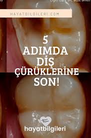 5 Adimda Dis Curuklerinden Kurtulun Dis Iyi Tavsiye Dogal Saglik