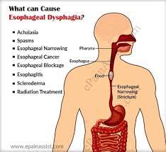 Food stuck in throat anatomy. What Causes Dysphagia And How Is It Diagnosed And Treated Dysphagia Dysphagia Causes Esophageal Spasm