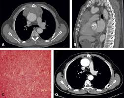Just in the same way as the difficulty of these cases; Solitary Fibrous Mediastinal Tumor With Coronary Vascular Supply An Unusual Case The Journal Of Thoracic And Cardiovascular Surgery