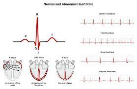 There are 17 conditions associated with irregular heartbeat and upset stomach. Arrhythmia Carolina Heart And Leg Center