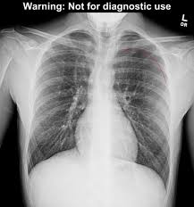 A large pneumothorax can squash the lung and cause it to collapse. Pneumothorax