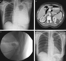 Meaning of effusion in english. Pleural Effusion Arising From A Rare Pancreatic Neoplasm European Respiratory Society