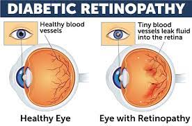 The good news is that identification and treatment of these eye problems is improving. Diabetic Eye Disease Wolfe Eye Clinic