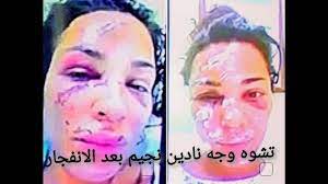 الممثلة نادين نجيم تقرر ترك لبنان. ØµÙˆØ± Ø­ØµØ±ÙŠÙ‡ Ù„ÙˆØ¬Ù‡ Ù†Ø§Ø¯ÙŠÙ† Ù†Ø¬ÙŠÙ… Ø¨Ø¹Ø¯ Ø§Ù†ÙØ¬Ø§Ø± Ø¨ÙŠØ±ÙˆØª Youtube