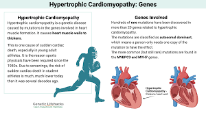 Image result for Cardiomyopathy