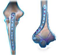 Arthrex - The Arthrex Elbow Fracture Plating System