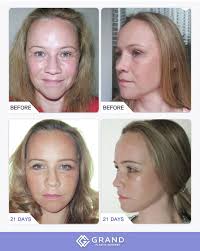 You Don T Have To Give Up Your Beauty Because Of Aging Get Your Youth Back With Gand S Anti Aging Surgery For Free Cons Plastic Surgery Beauty Rhinoplasty