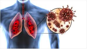 Measure your peak flow rate close to the same time each day. What Does Covid 19 Do To The Lungs