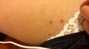 And if so, how do you treat flea bites? I Have A Bug Bite In The Shape Of A Triangle Album On Imgur