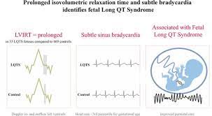 Left Ventricular Isovolumetric Relaxation Time Is Prolonged In Fetal Long Qt Syndrome Circulation Arrhythmia And Electrophysiology