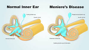 Image result for Inner Ear Decompression Sickness