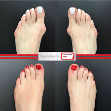 Bunions Foot First Podiatry Centers Bunion Bunion Remedies Bunion Surgery
