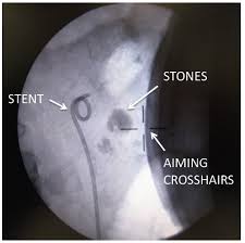 Shockwave Lithotripsy For Kidney Stones Eswl Kidneystoners Org