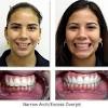 Braces, on the other hand, can take closer to two years. 1