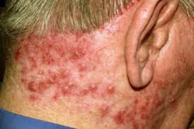 Image result for Deep Folliculitis