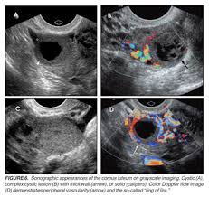 Image result for corpus luteum sonography)