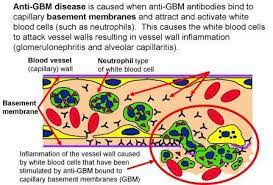 It is defined by the presence of autoantibodies directed at specific antigenic targets within the glomerular basement membrane. Anti Gbm Disease Unc Kidney Center