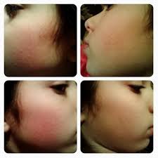 Pin By Michelle Holden On My Pesky Rosacea Rosacea Symptoms Keratosis Pilaris Acne Rosacea