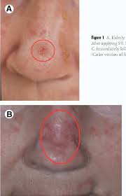 The strongest risk factor for developing skin cancer is ultraviolet (uv) ray exposure, typically from the sun. Pdf Treatment Strategies For On Melanoma Skin Cancer And Precursor Lesions Semantic Scholar