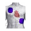 Ablation has become increasingly important as an adjunctive therapy to reduce shocks in icd recipients. 1