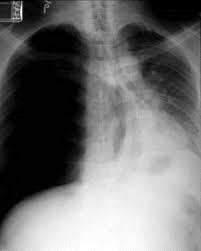 Image result for Pneumothorax