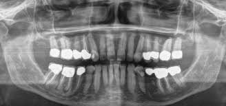 In diesem fall wäre eine erneute wurzelkanalbehandlung notwendig. Endodontie Wurzelbehandlung Zahnarzt Dr Peter Andre Weil Hamburg