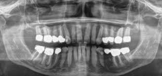 In diesem fall wäre eine erneute wurzelkanalbehandlung notwendig. Endodontie Wurzelbehandlung Zahnarzt Dr Peter Andre Weil Hamburg