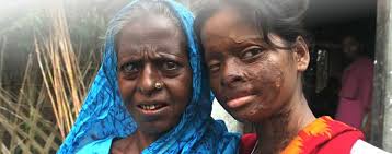 Clear instruction and official deletion page link. Bangladeshi Acid Attack Victim Hasina Akter Finds Empowerment Faces The Man Who Disfigured Her Mama Asia Abc News