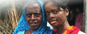 The marriage ceremony was held last sunday at 9 pm. Bangladeshi Acid Attack Victim Hasina Akter Finds Empowerment Faces The Man Who Disfigured Her Mama Asia Abc News