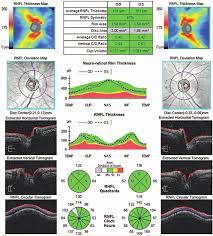 Understanding Glaucoma Test Results: What Do They Mean?