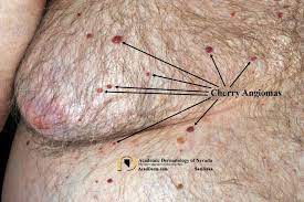 The papules seldom appear on the hands and feet. Cherry Angioma Senile Angioma Academic Dermatology Of Nevada