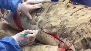 You incise along the full length of the eschar extending in to viable unburned tissue. Idea Series Jetem Innovation A Low Cost Escharotomy Simulation Model For Residency Education