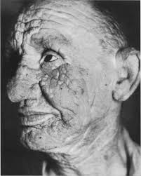 Ablagerungskrankheiten körpereigener Stoffwechselprodukte