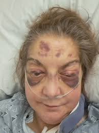 Weight Gain and POTS Syndrome Management