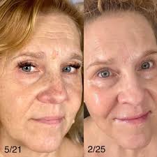 How Pomifera has changed my skin & confidence!