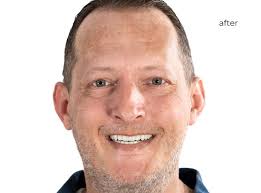 24 Hour Dental Implants in Chicago