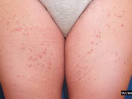 Bleeding occurs due to a weakening of the blood vessels present in the dermis layer of the skin. Capillaritis Dermnet Nz