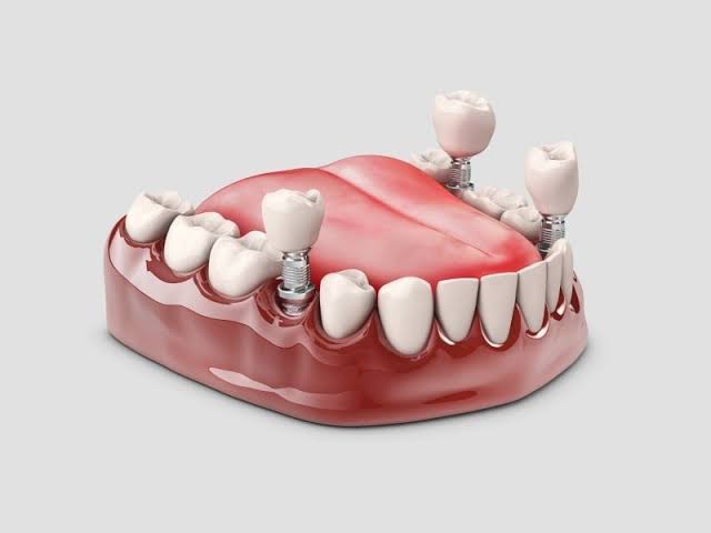 Implant Treatment in Istanbul | MosDent Dental Hospital