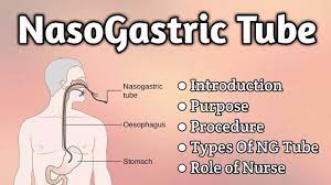 May 10, 2021 · nasogastric tubes are part of the standard of care in treating intestinal obstruction and can also be used to provide nutritional support. Nasogastric Tube Intubation Youtube