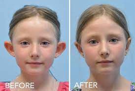 Is there any way to make your ears not stick out? Protruding Ears Prominent Ears Diagnosis Treatment Options