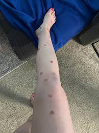 Found out Im allergic to mosquitos. As of they werent infuriating enough.  : rmildlyinfuriating